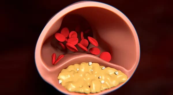 High Cholesterol and Triglycerides