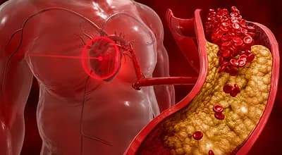 High cholesterol and abnormal fat levels