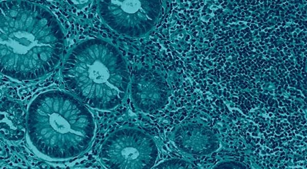 Dysbiosis of the Gut Microbiome 
