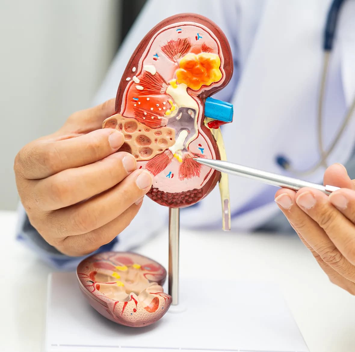 What are Hypertension and Chronic Kidney Disease (CKD)?