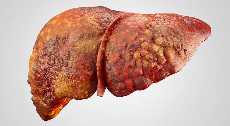 Liver scarring (fibrosis and cirrhosis)