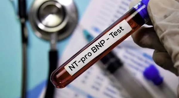 NT-proBNP