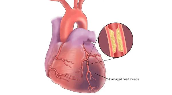 Coronary artery disease