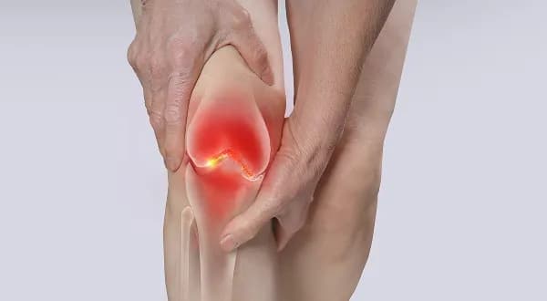Joint Damage and Osteoarthritis