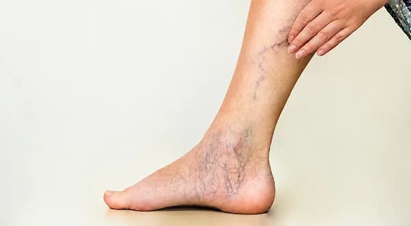 Blocked arteries in legs