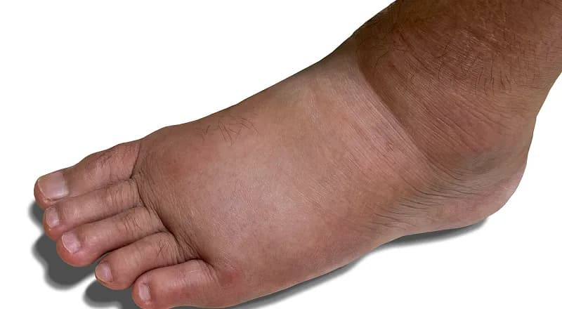 Charcot Foot 