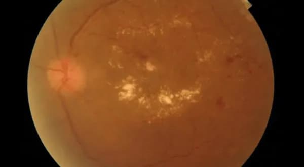 Diabetic Macular Oedema