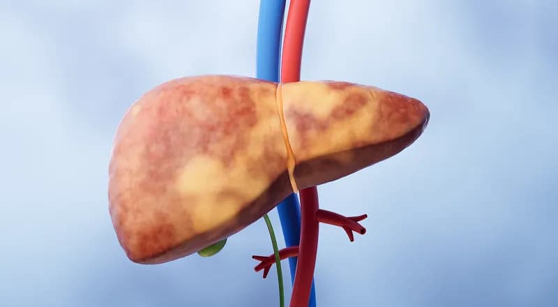 Non-Alcoholic Fatty Liver Disease 