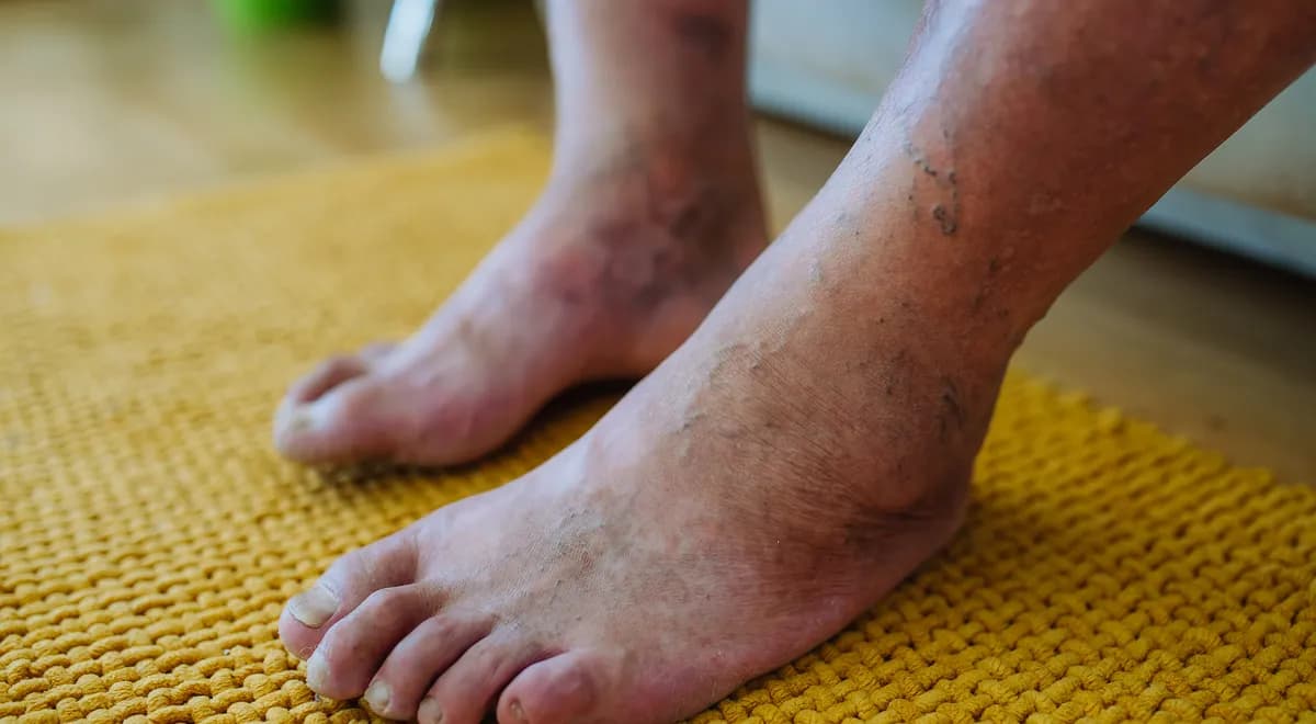 Peripheral Artery Disease