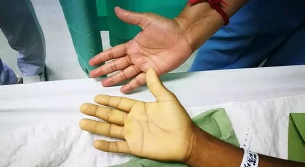 Anaemia