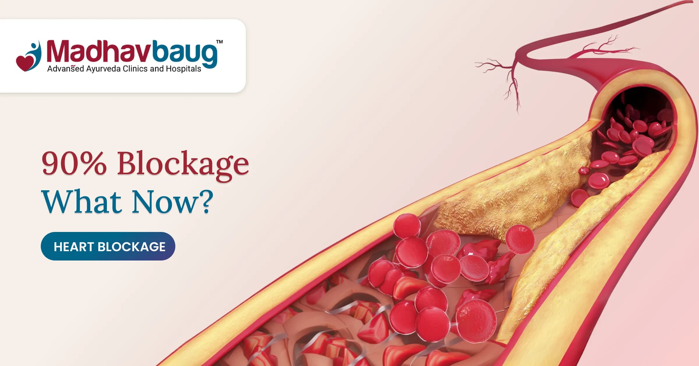 90% Heart Blockage Treatment, Symptoms and Tests 
