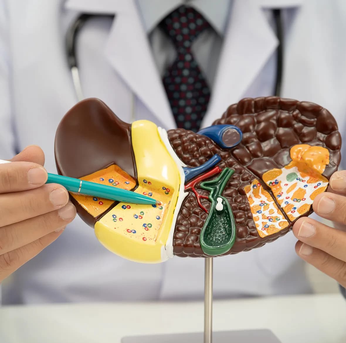 What Is Fatty Liver Disease?