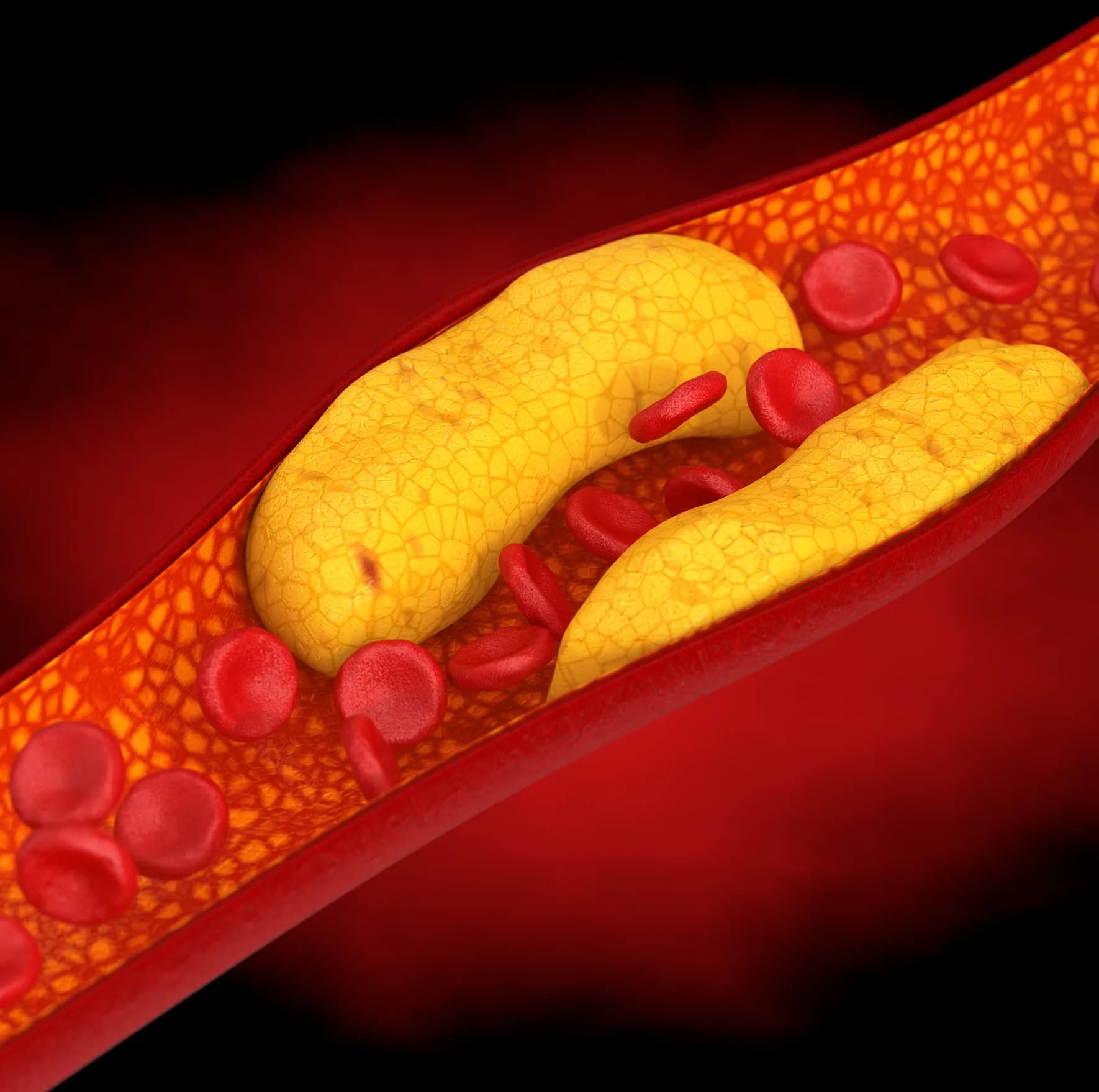 What Is High Cholesterol?