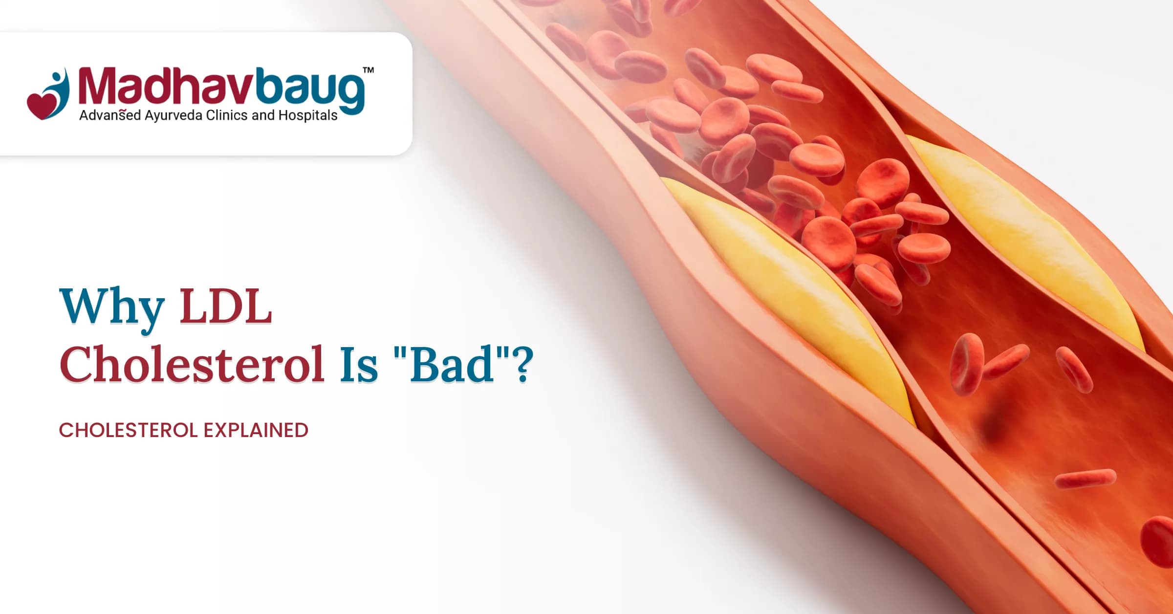 What Is LDL Cholesterol and Why Is It Called Bad Cholesterol?